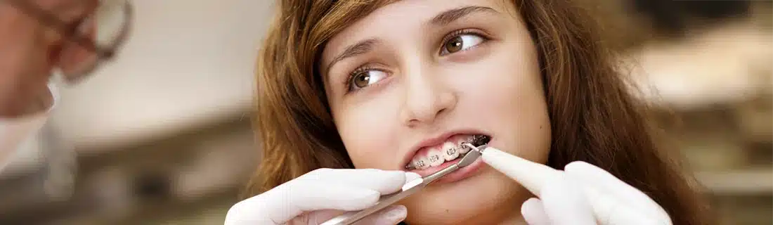 Child Braces Dentist Cleaning CS1